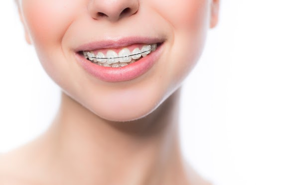 How Often Do Orthodontists Have to Tighten Braces?