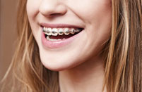 smile with braces